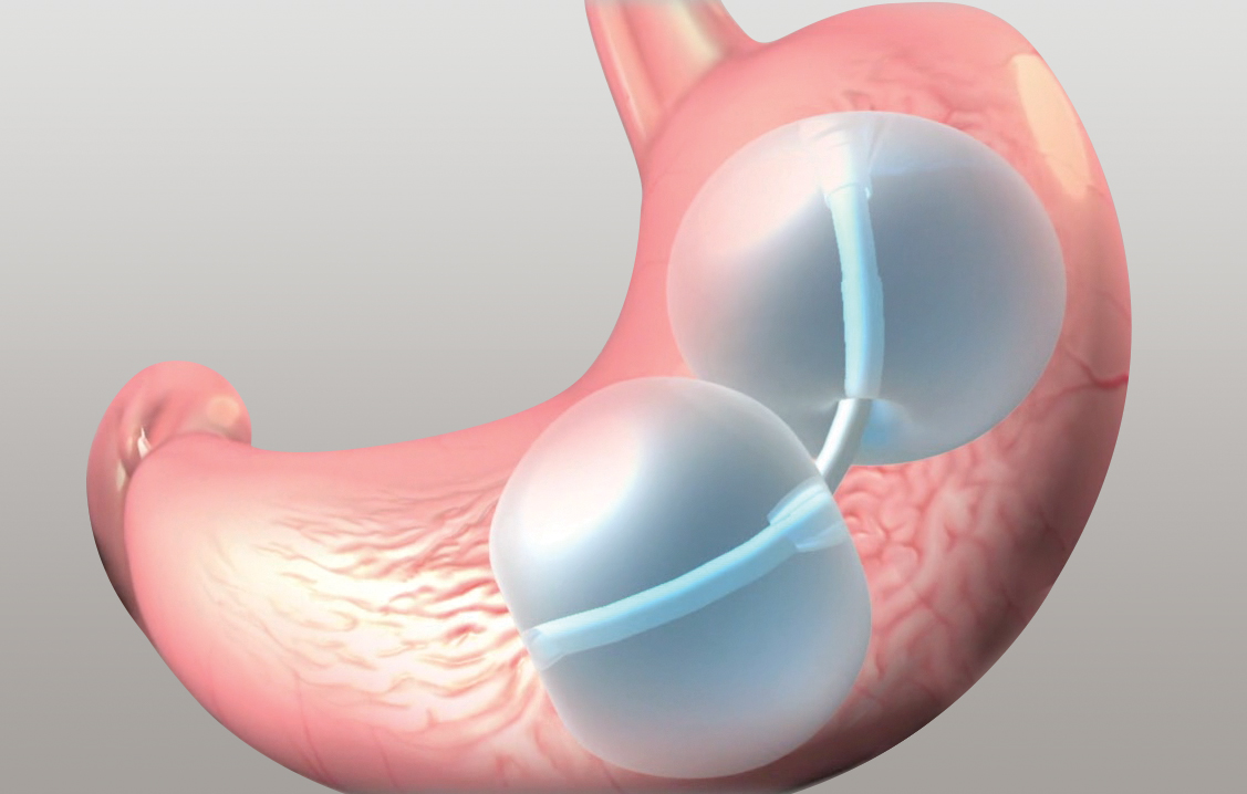 Gastric Balloon Melbourne - Complete Weight Loss Solution